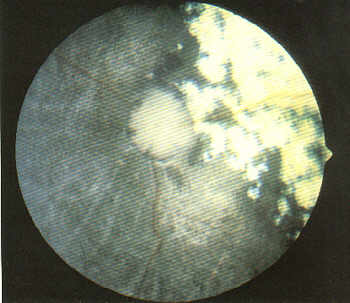 Progressive Tetina Atrophie (PRA)